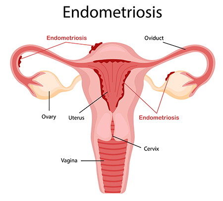 An anatomical diagram showing endometrial tissue growing outside of the uterus on an ovary, an oviduct and other parts of the pelvis.
