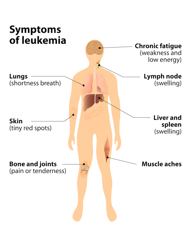 An illustration of where symptoms of leukemia affect the body.