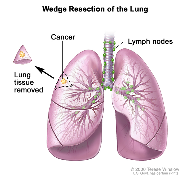 A medical illustration of a wedge resection of the lung.