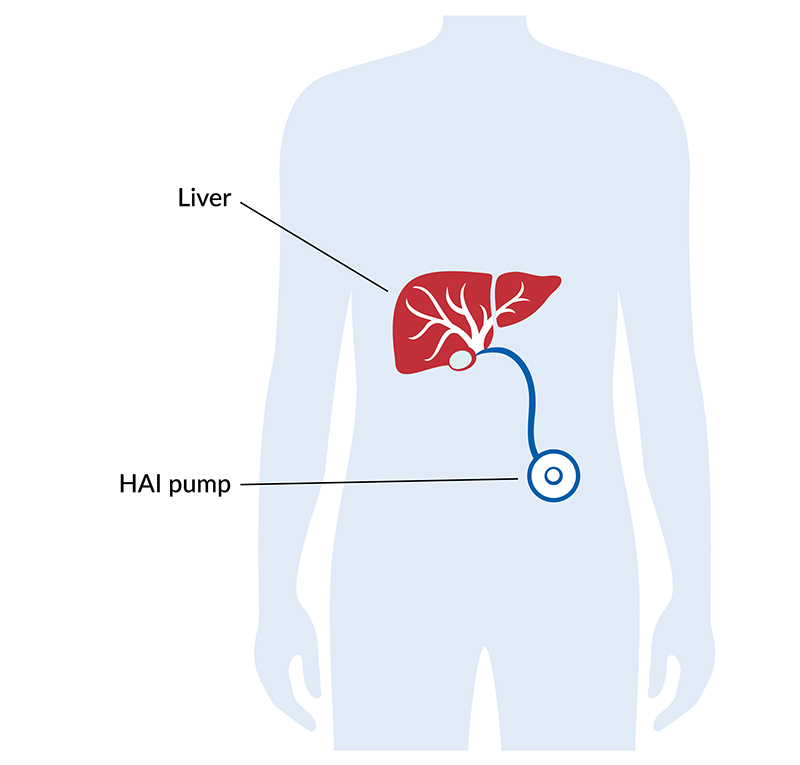 This simple illustration depicts a human torso with the liver highlighted in red. A small pump, about the size and shape of a hockey puck, sits inside the abdomen. The pump is connected to the liver by a thin tube.