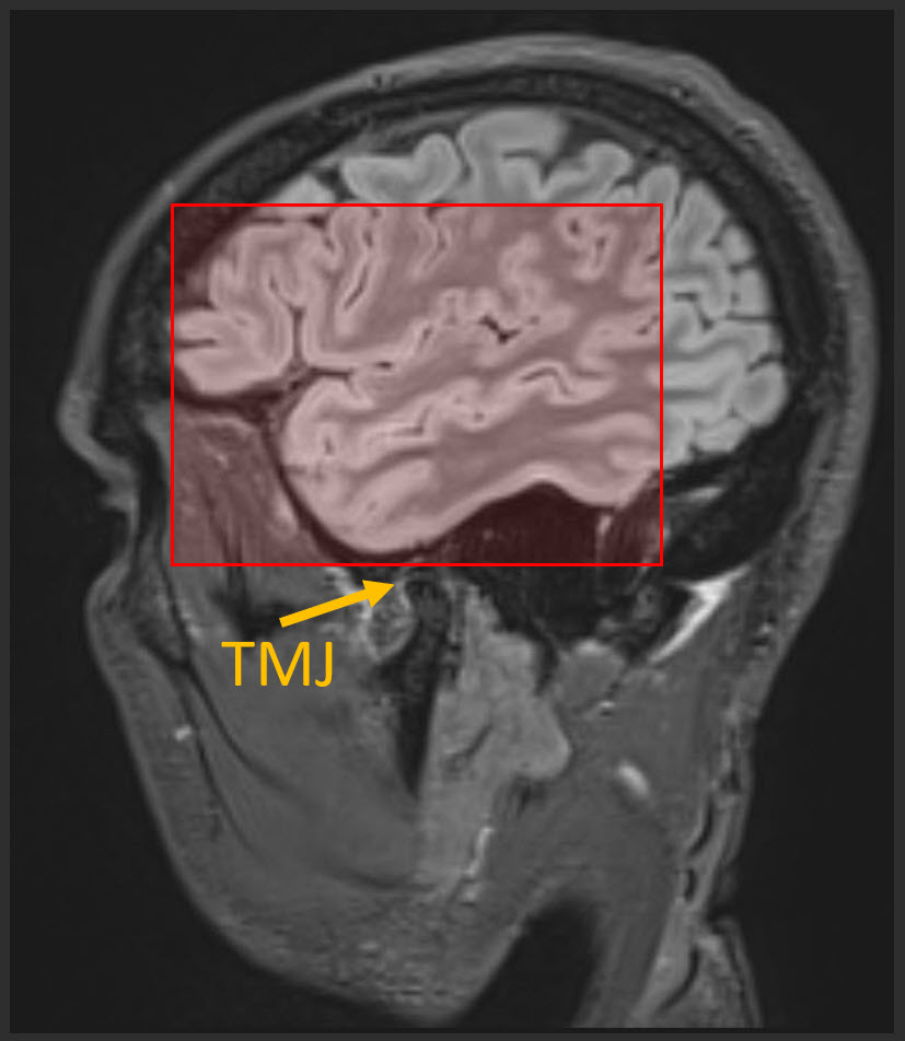 Sagittal FLAIR image showing anatomic coverage this MMRI sequence. 
