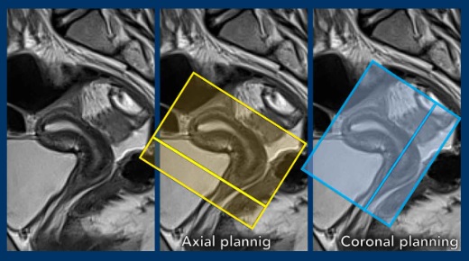 MRI Cervical CA Coverage Img 4