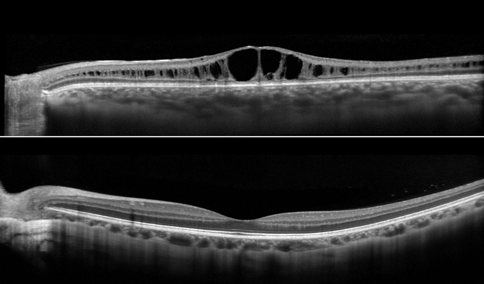 Two OCT scans on top of one another showing a health retina and a diseased retina.