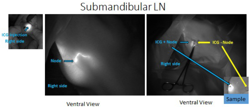 image represents the use of fluorescence imaging to identify the draining lymph node in the submandibular region after a intraepithelial injection of indocyanine green (ICG) in the oral mucosa.