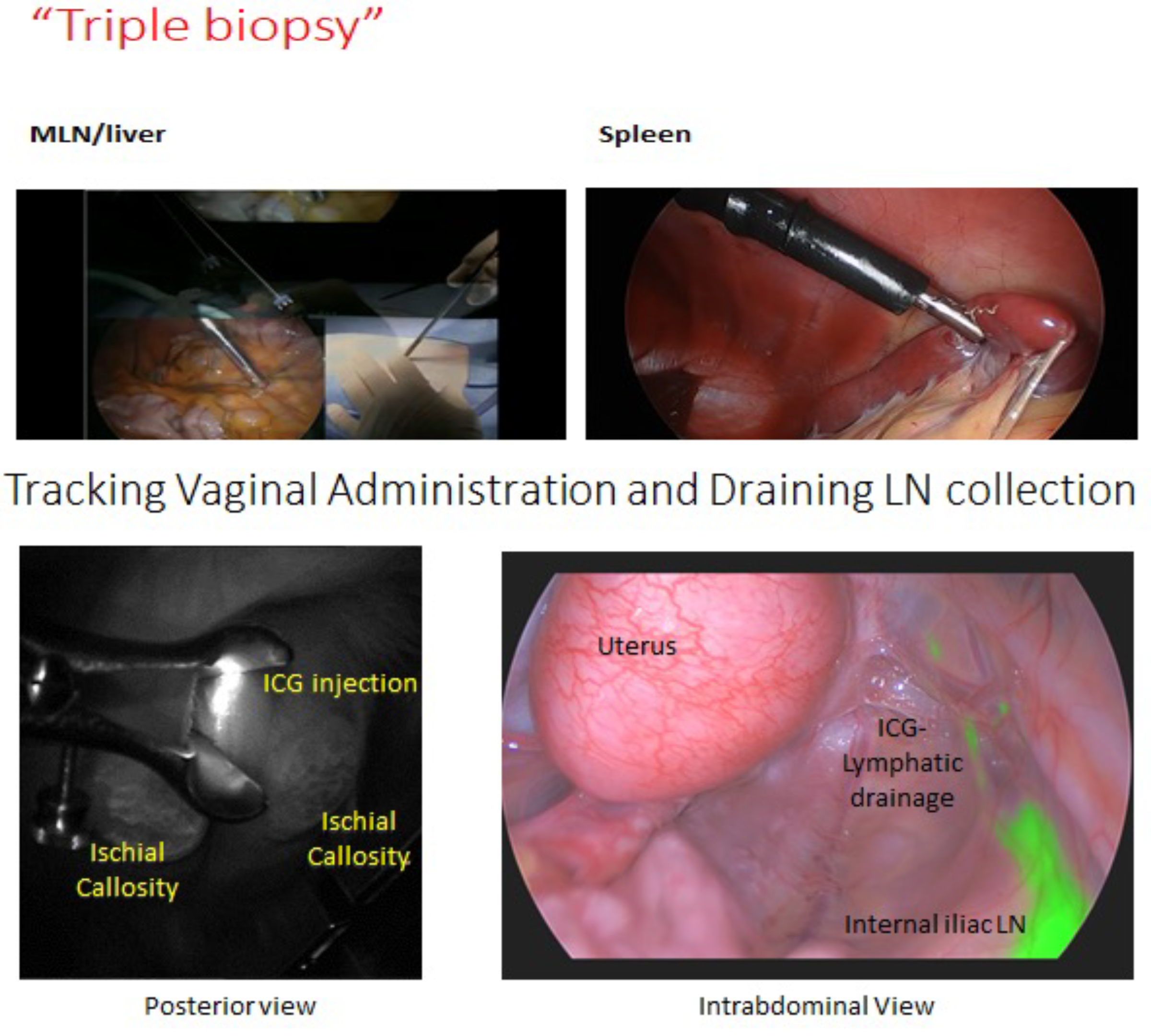 The second image represents the use of laparoscopic techniques to do minimally invasive biopsies of the spleen, mesenteric lymph nodes and liver.   The final image is the use of ICG to identify the draining lymph node after an intraepithelial injection of ICG in the vaginal mucosa. 