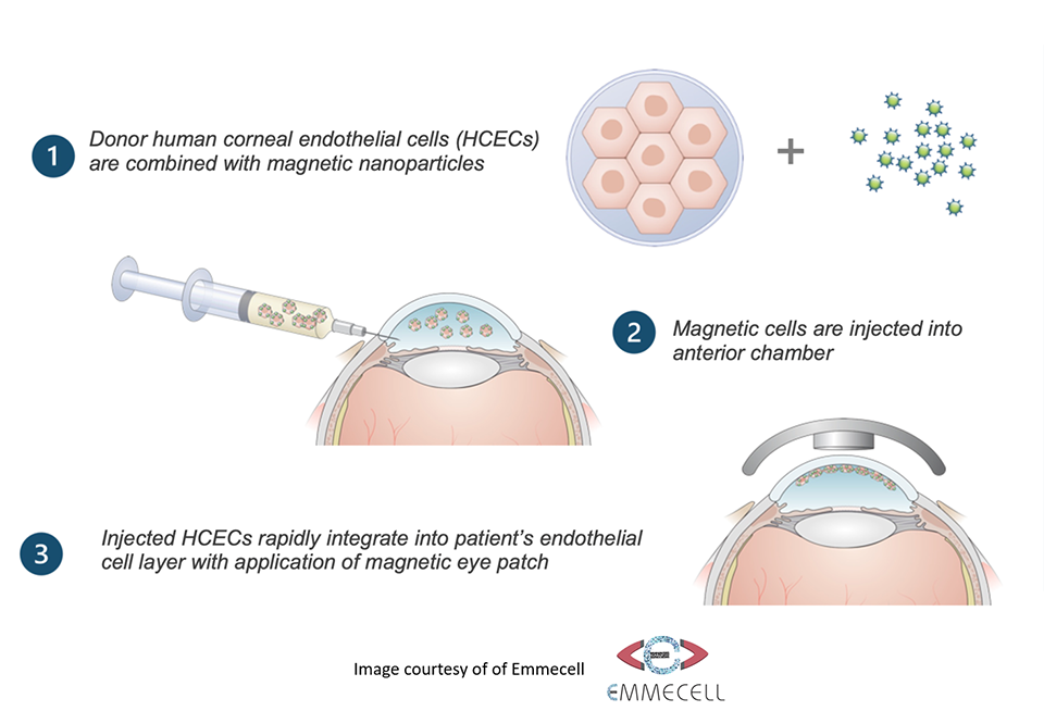 Infographic of the three steps in a clinical trial to fixed a damaged cornea.