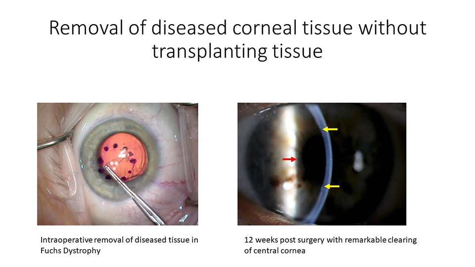 Two side by side images showing a corneal transplant using a new techniqe, and on the right is an eye in a dark room showing clear cornea.