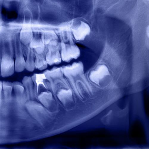 Xray image of half a human jaw.