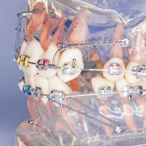 Clear plastic jaw with plastic teeth and metal braces.