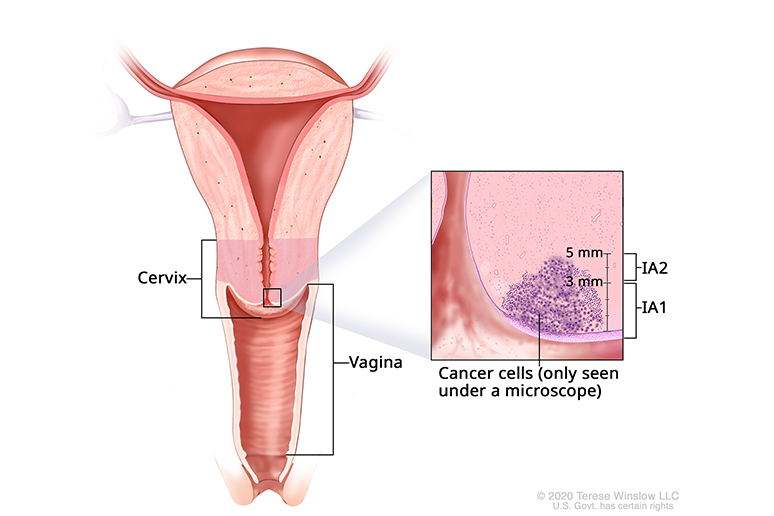 A drawing shows microscopic cancer cells at the bottom of the cervix, a cylinder-shaped organ that connects the uterus, above, and the vagina, below.