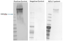Three Western blot test strips. The positive control strip shows a band for the NELL1 protein above 250 kDa. The negative control strip shows no band. The NELL1 patient strip shows a band, similar to the positive control strip.