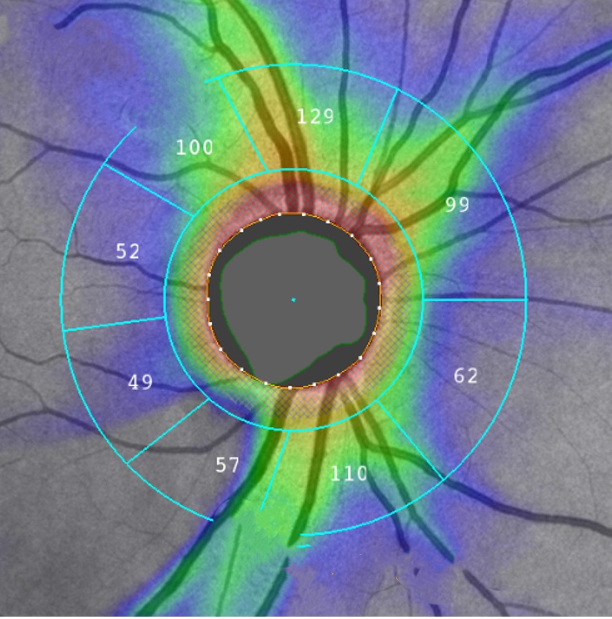 An image of the back of the eye is shown by a black circle in the middle ringed by red, then green and purple radiate out.