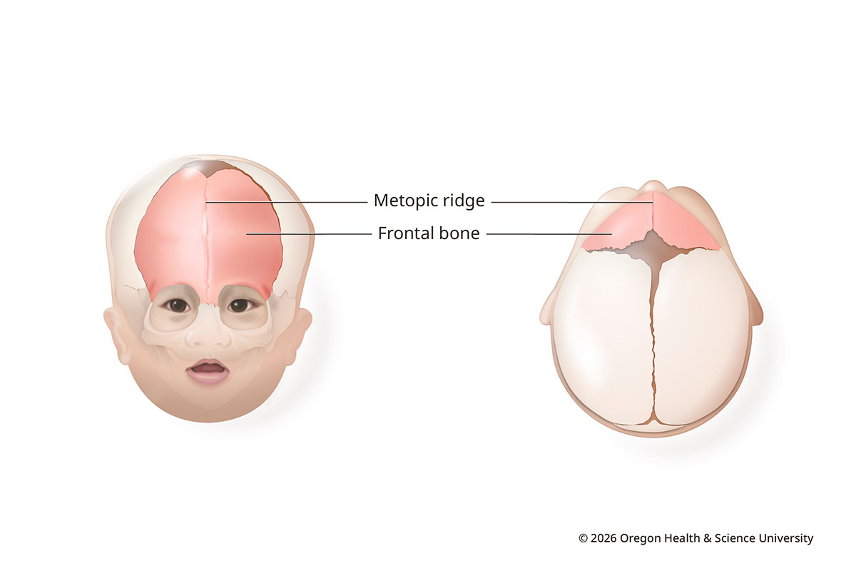 Skull Anomaly Craniosynostosis OHSU