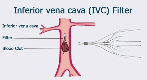 Illustration of the inferior vena cava showing where the IVC filter goes to stop a blood clot