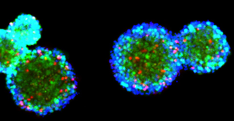 The image shows a microscopic view of glioblastoma cells and tissue, stained blue and green.