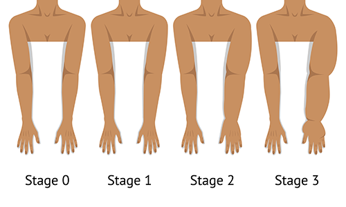 An illustration shows four pairs of arms, with one arm growing more swollen as the patient moves from stage 0 to stage 3.