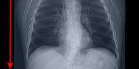 CT Protocol Mediastinal Lung Image