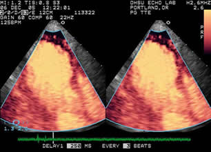 A myocardial contrast echocardiography scan.