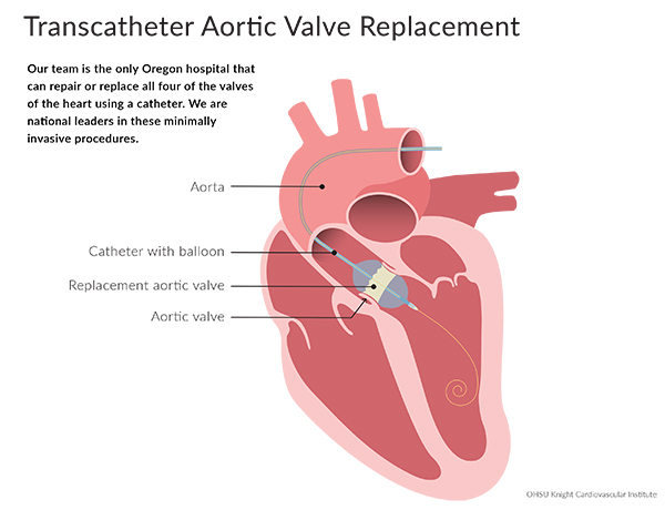Medical illustration of Transcatheter aortic valve replacement
